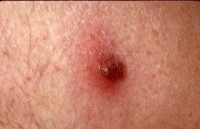 Intradermal Nevus Keterangan Spesies