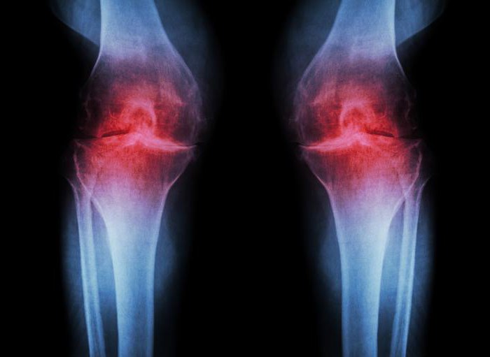 kako liječiti bol u zglobovima nakon treninga može li bol u zglobovima dati temperaturu