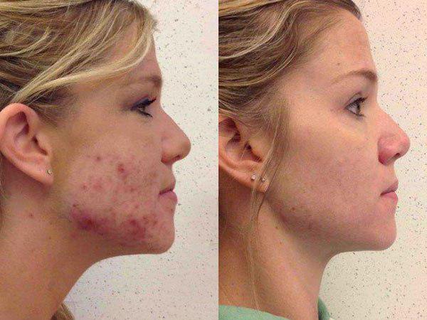 roaccutane pille