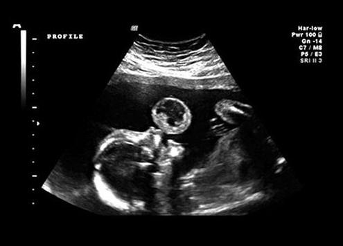 Үштік жүктілік Үштік жүктілік