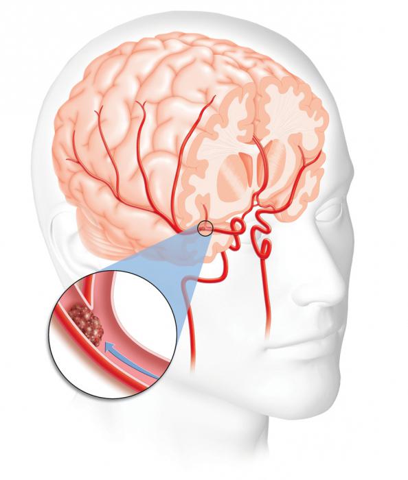 hemoragijski moždani udar i hipertenzija)