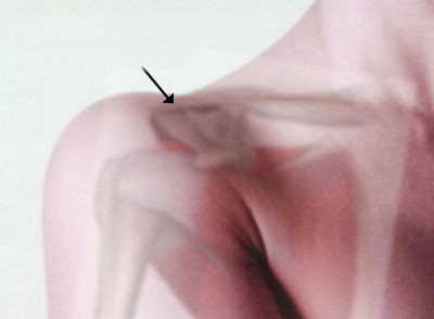 Akromioklavikularna zglobna artroza (osteoartritis)