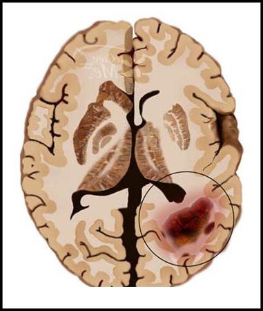 Kanser Otak: Punca, Gejala dan diagnosis