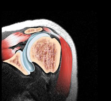 liječenje osteoartritisa acromioclavicular bol u desnom zglobu ramena što učiniti
